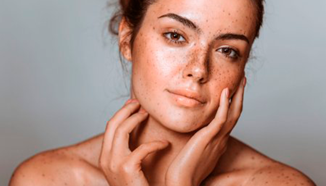 5 tratamientos para eliminar las manchas en la piel