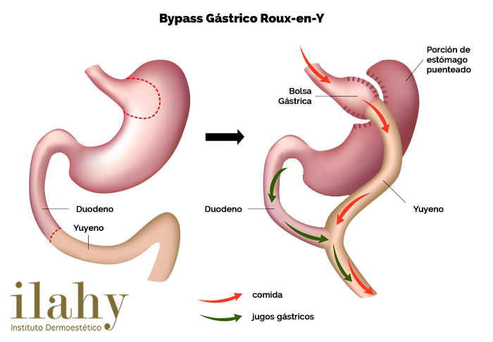 bypass gastrico para perder peso