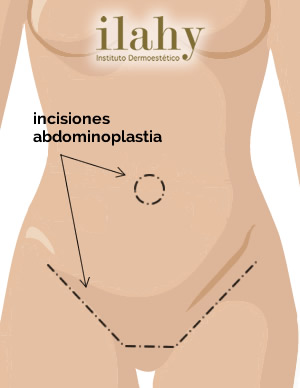 https://www.ilahy.es/wp-content/uploads/2015/03/operacion-abdominoplastia.jpghttps://www.ilahy.es/wp-content/uploads/2015/03/operacion abdominoplastia