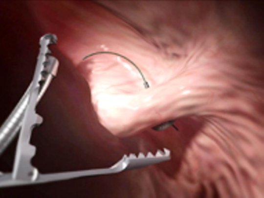 Método POSE en Alicante