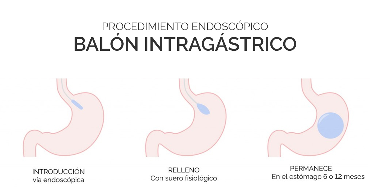 ¿Cómo se inserta el balón gástrico?