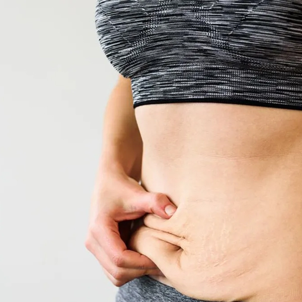 ¿Qué es una mini abdominoplastia? Diferencias entre abdominoplastia y mini abdominoplastia.