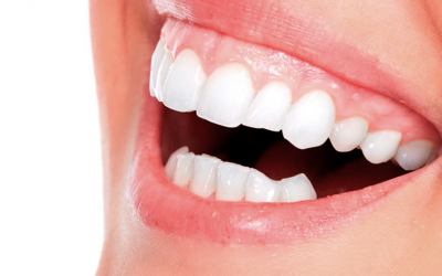 Sonrisa gingival ¿Cómo corregirla?