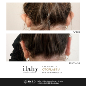 Otoplastia (antes y después)