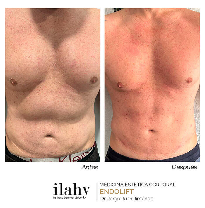 Endolift antes y despúes