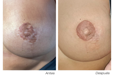 antes y después micropigmentación areola