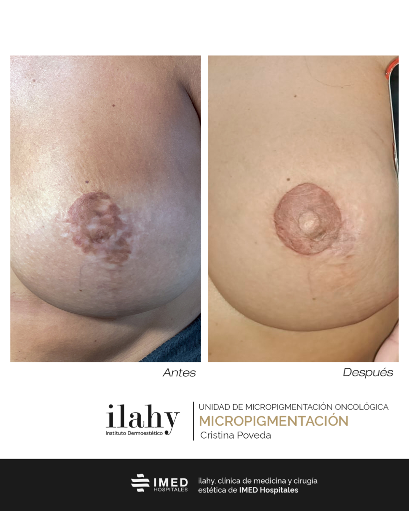 antes y después micropigmentación areola