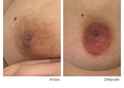antes y después micropigmentación areola