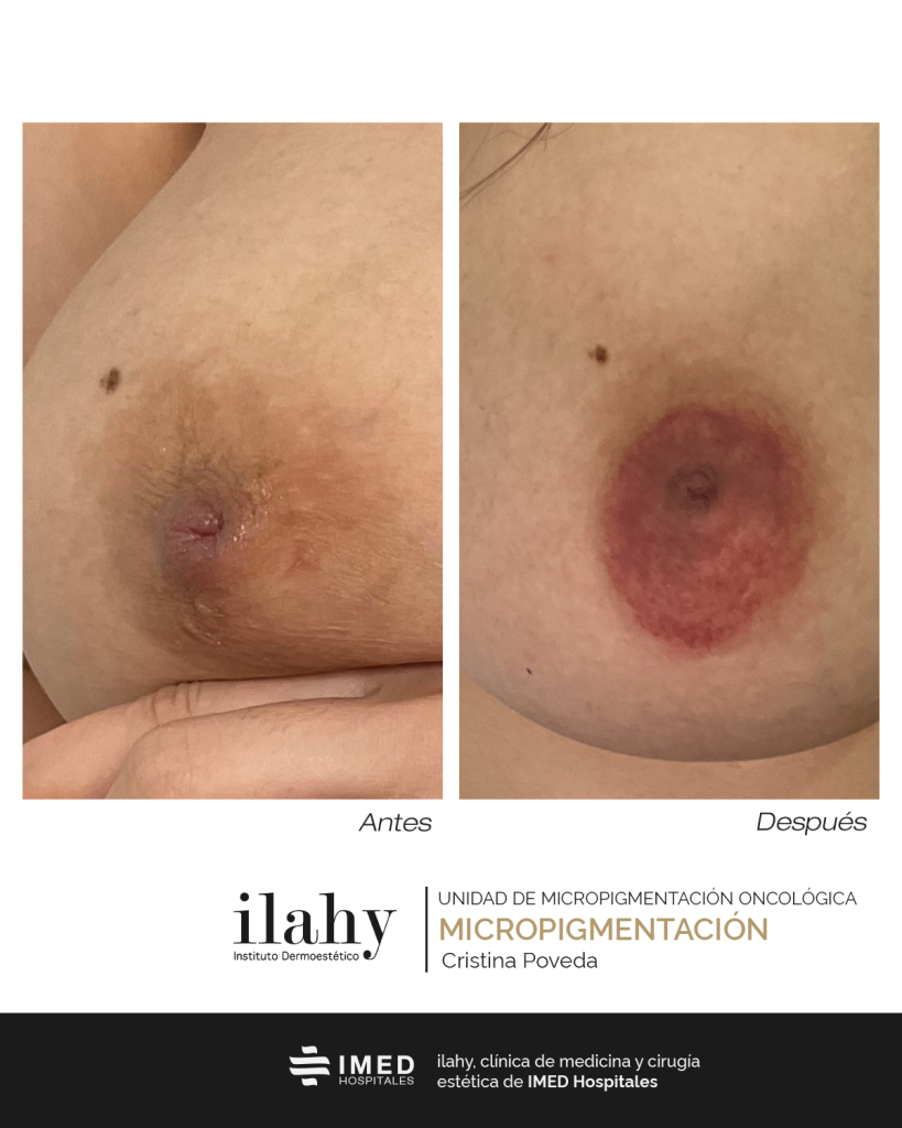 antes y después micropigmentación areola